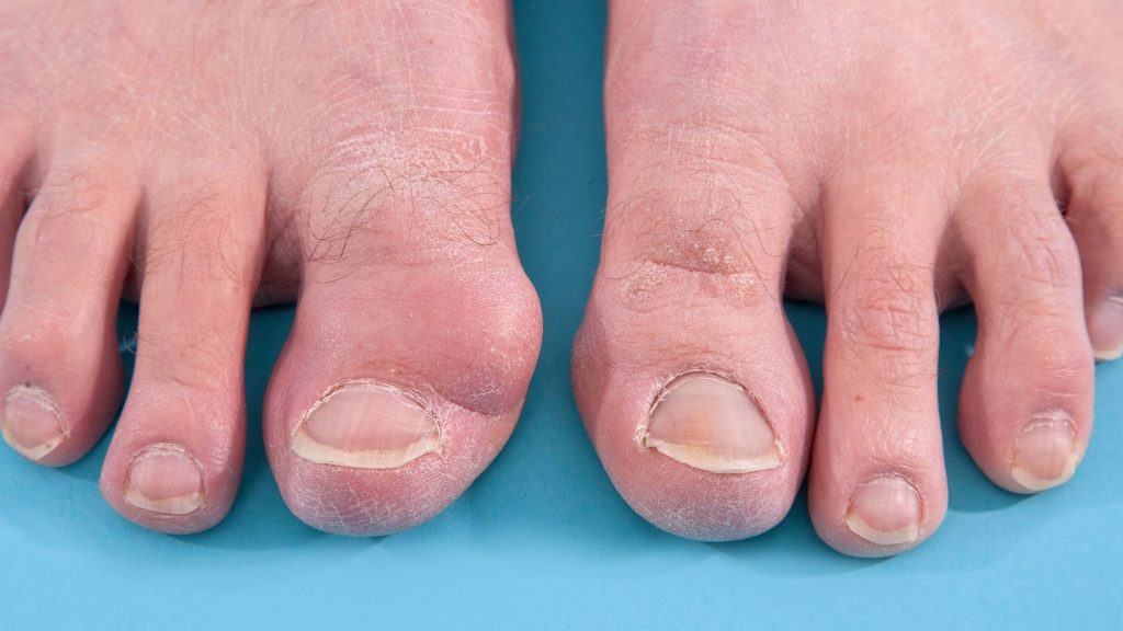 bony bump - A Symptom of bunions on feet 