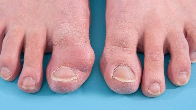 big-toe-bunion-all-about-symptoms-causes-and-pain-relief-treatments