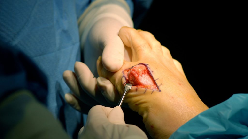 A person undergoing big toe bunion treatment